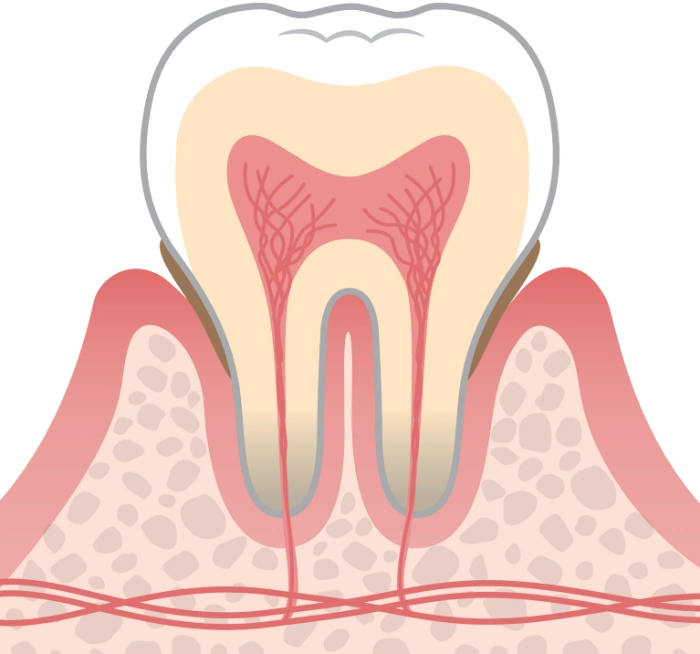 初期歯周病