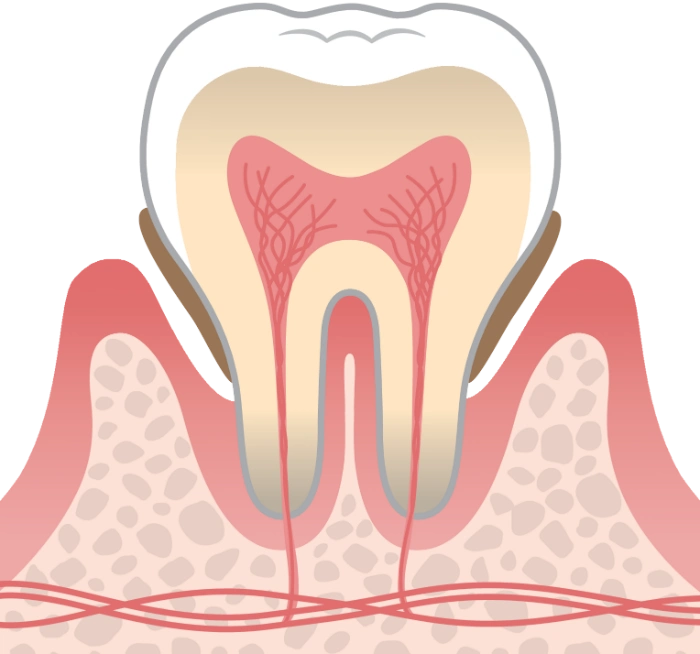 中期歯周病