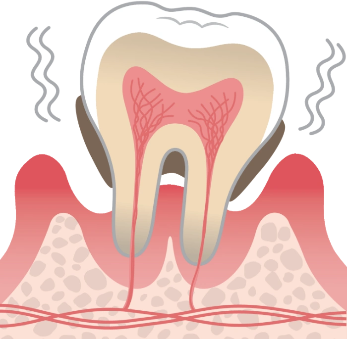 末期歯周病